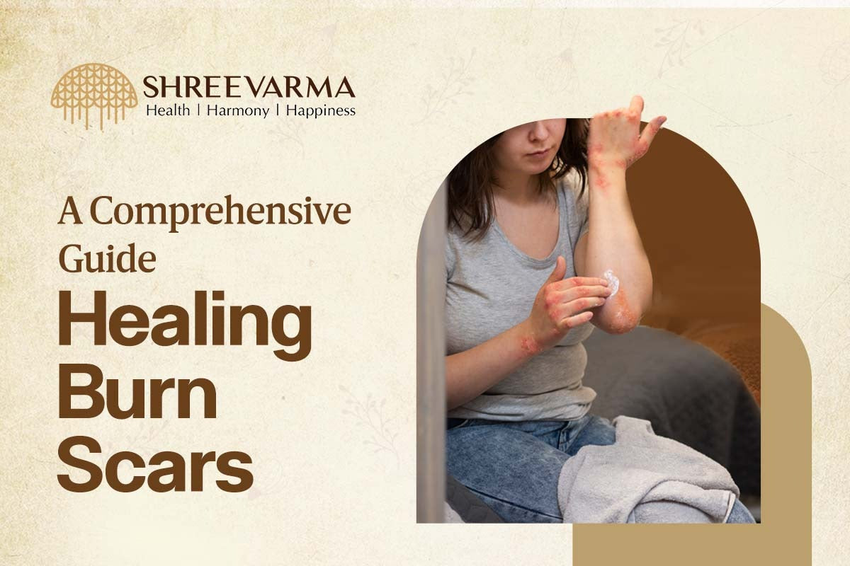     Ayurvedic Treatment for burn scars – SHREEVARMA BIO NATURALS PVT. LTD