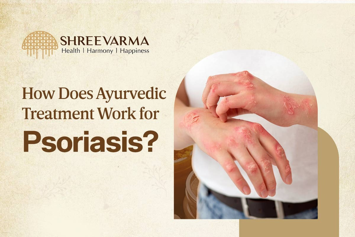 How Does Ayurvedic Treatment Work for Psoriasis